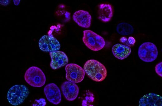 ΚΑΡΚΙΝΟΣ ΣΤΟ ΠΑΓΚΡΕΑΣ ΙΣΠΑΝΙΑ