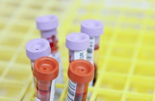 ΗΛΙΚΙΩΜΕΝΟΙ ΑΙΜΑΤΟΛΟΓΙΚΗ ΕΞΕΤΑΣΗ ΕΞΕΤΑΣΗ ΑΙΜΑΤΟΣ