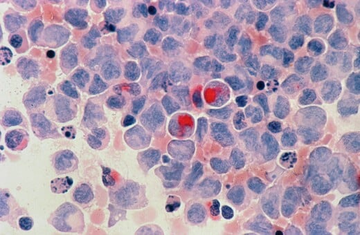 ΚΑΡΚΙΝΟΣ ΝΕΟΙ ΑΥΞΗΣΗ ΑΓΓΛΙΑ