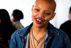 Η «μούσα» της Rihanna αποκάλυψε πως κάνει χημειοθεραπείες: Μην μου συμπεριφέρεστε σαν θύμα