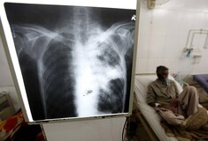 Το lockdown «παραλύει» την καταπολέμηση της φυματίωσης - Φόβοι για 1,4 εκατ. επιπλέον νεκρούς