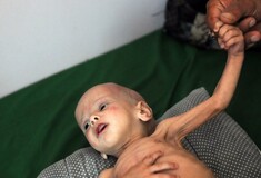 Λιμοκτονία στην Υεμένη - Σκοτώνουν μια ολόκληρη γενιά παιδιών