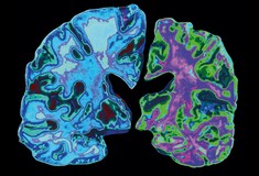 Γιατί η νόσος του Αλτσχάιμερ εξακολουθεί να είναι ένα ιατρικό μυστήριο;