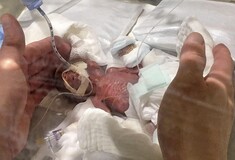 Το μικρότερο νεογέννητο αγόρι στον κόσμο γεννήθηκε μόλις 268 γραμμάρια