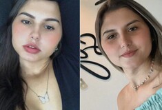 Βραζιλία: Δίδυμες αδελφές υποβλήθηκαν ταυτόχρονα σε επέμβαση επαναπροσδιορισμού φύλου