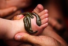 Πώς και γιατί οι βδέλλες επιστρέφουν ως μορφή θεραπείας στη σύγχρονη ιατρική