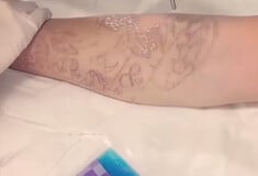 Ο τρόπος που αφαιρείται το τατουάζ από το δέρμα
