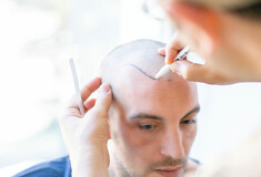 Όσα χρειάζεται να γνωρίζετε για την μεταμόσχευση μαλλιών