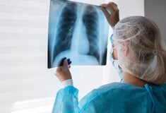 Καρκίνος του πνεύμονα: Νέο φάρμακο καταγράφει ανέλπιστα αποτελέσματα από οποιαδήποτε άλλη θεραπεία στην ιστορία
