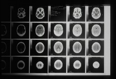 Καναδάς: Ενδείξεις για νέα μυστηριώδη νευρολογική ασθένεια - Επιστήμονες καταγγέλουν απαγόρευση μελέτης 