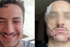 Γαλλία: Φοιτητής αυτοκτόνησε έπειτα από αποτυχημένη μεταμόσχευση γενειάδας στην Τουρκία