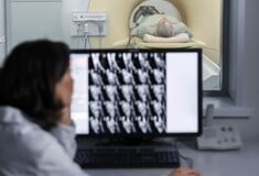 Ιστορικό άλμα στη θεραπεία του καρκίνου κεφαλής-τραχήλου με ανοσοθεραπεία