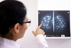 Νέα «θεραπεία-ορόσημο» σταματά τον καρκίνο του μαστού προτού εξελιχθεί – Τι δείχνει μεγάλη μελέτη