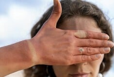 Ηλίαση: Συμπτώματα και τρόποι αντιμετώπισης