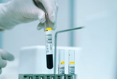Νέα επαναστατική εξέταση αίματος δίνει ελπίδες για έγκαιρη διάγνωση 50 μορφών καρκίνου