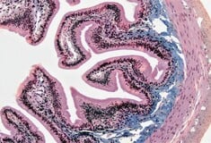 Κατανάλωση UPFs τροφίμων και καρκίνος του εντέρου: Τι δείχνει νέα μελέτη