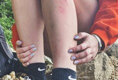 Αυξάνονται τα ποσοστά ψωρίασης παγκοσμίως: Γιατί επιβαρύνονται περισσότερο οι εύπορες χώρες