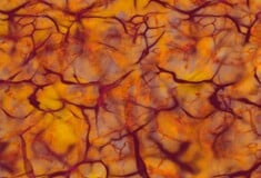 ΙΣΩΣ ΓΙΑ ΣΚ - Σκλήρυνση κατά πλάκας: Ανακαλύφθηκαν δύο υποτύποι με τη βοήθεια της τεχνητής νοημοσύνης 