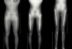 Κωνσταντινούπολη: Η μηχανή που σε κάνει να ψηλώνεις 