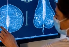 ΚΑΡΚΙΝΟΣ ΜΑΣΤΟΥ ΘΕΡΑΠΕΙΑ