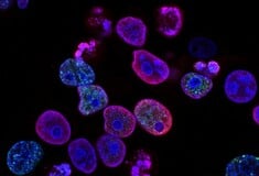 ΚΑΡΚΙΝΟΣ ΣΤΟ ΠΑΓΚΡΕΑΣ ΙΣΠΑΝΙΑ