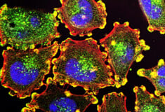 ΚΑΡΚΙΝΟΣ ΣΤΟ ΠΑΓΚΡΕΑΣ ΔΙΑΓΝΩΣΗ