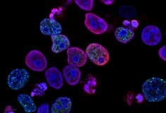 ΚΟΛΟΝΟΣΚΟΠΗΣΗ ΚΑΡΚΙΝΟΣ ΕΝΤΕΡΟ ΠΟΛΥΠΟΔΑΣ