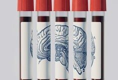 ΑΝΟΙΑ ΕΞΕΤΑΣΗ ΑΙΜΑΤΟΣ ΑΛΤΣΧΑΙΜΕΡ