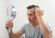 Η πιο προηγμένη μέθοδος μεταμόσχευσης μαλλιών αποκαθιστά την τριχοφυΐα