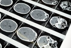 Τι είναι το ανεύρυσμα εγκεφάλου και πώς αναγνωρίζεται πριν από μια ρήξη;