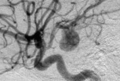 Τι είναι το ανεύρυσμα εγκεφάλου και πώς αναγνωρίζεται πριν από μια ρήξη;