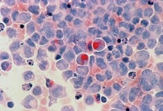 ΚΑΡΚΙΝΟΣ ΝΕΟΙ ΑΥΞΗΣΗ ΑΓΓΛΙΑ