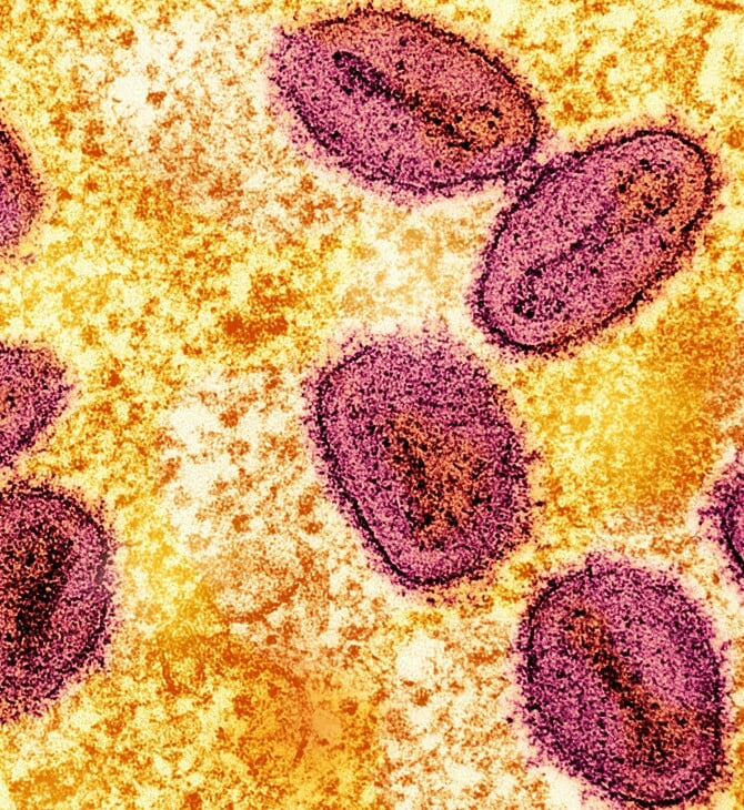Το πιο επιθετικό στέλεχος της mpox εντοπίστηκε σε κάτοικο της Καλιφόρνια – Χωρίς επαφή με το εξωτερικό