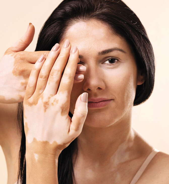 Αντιμετωπίζουμε τη λεύκη με τη βοήθεια του δερματολόγου