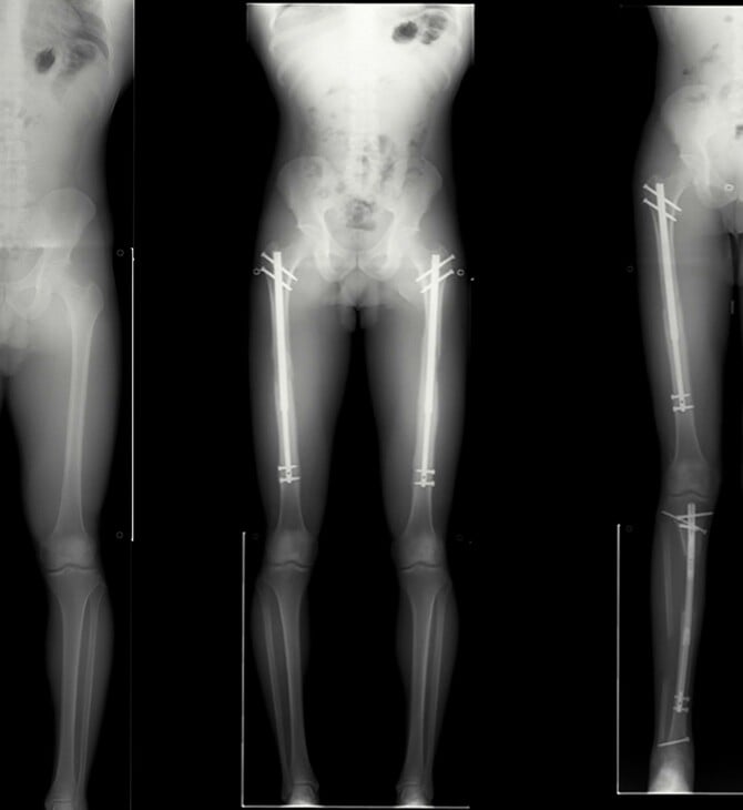 Κωνσταντινούπολη: Η μηχανή που σε κάνει να ψηλώνεις 