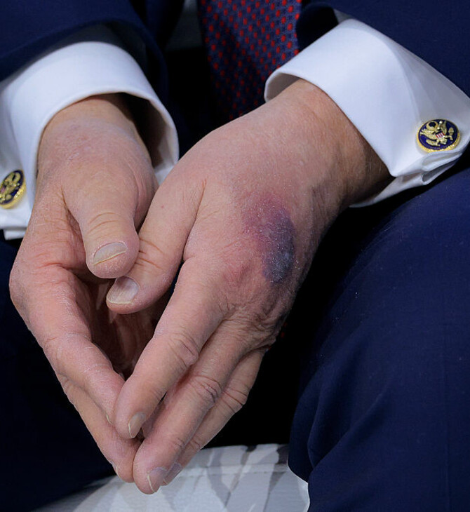 ΤΡΑΜΠ ΜΩΛΩΠΕΣ ΤΡΑΥΜΑΤΙΣΜΟΣ ΥΓΕΙΑ