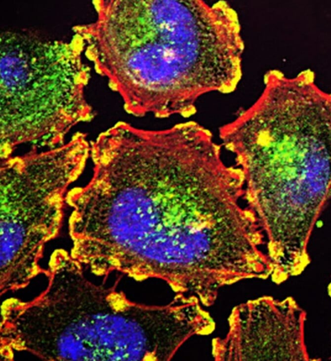 ΚΑΡΚΙΝΟΣ ΣΤΟ ΠΑΓΚΡΕΑΣ ΔΙΑΓΝΩΣΗ