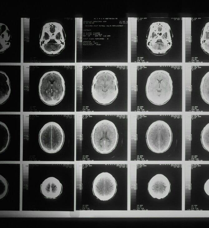 ALS ΑΜΥΟΤΡΟΦΙΚΗ ΠΛΕΥΡΙΚΗ ΣΚΛΗΡΥΝΣΗ 