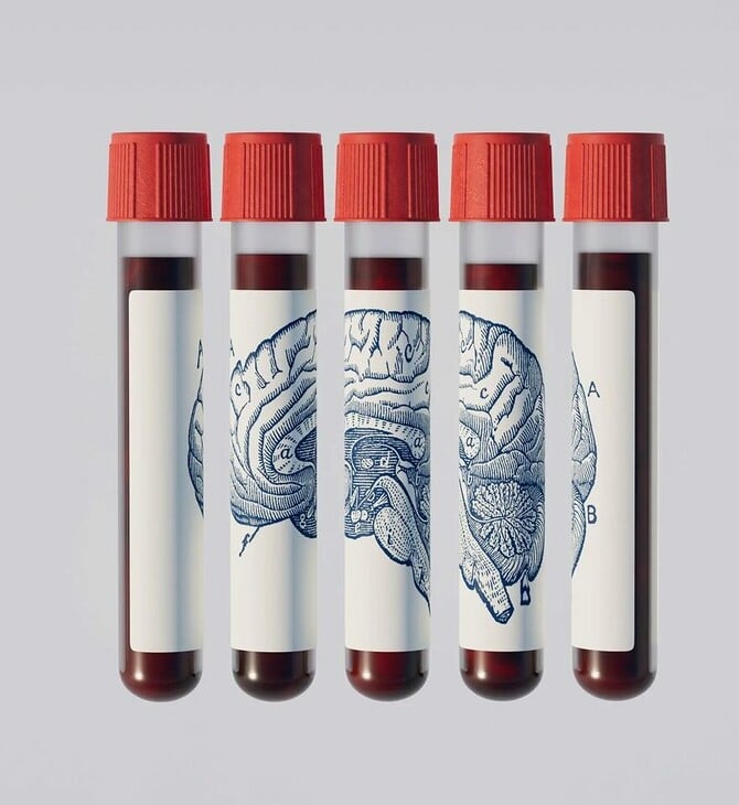 ΑΝΟΙΑ ΕΞΕΤΑΣΗ ΑΙΜΑΤΟΣ ΑΛΤΣΧΑΙΜΕΡ