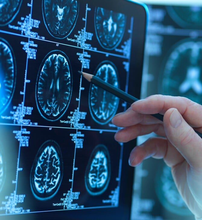 «Πρωτοποριακά φάρμακα» για το Αλτσχάιμερ είναι απίθανο να ωφελήσουν ασθενείς, σύμφωνα με μελέτη