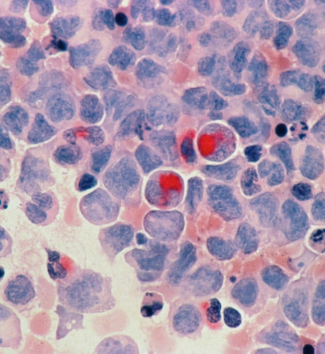 ΚΑΡΚΙΝΟΣ ΝΕΟΙ ΑΥΞΗΣΗ ΑΓΓΛΙΑ