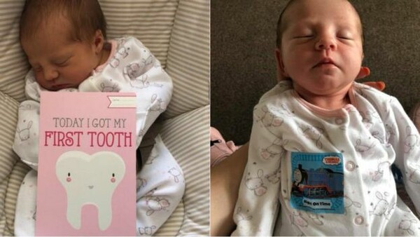 Βρέφος γεννήθηκε με δόντι - Σε ηλικία 12 ημερών έγινε ο νεότερος ασθενής σε οδοντίατρο