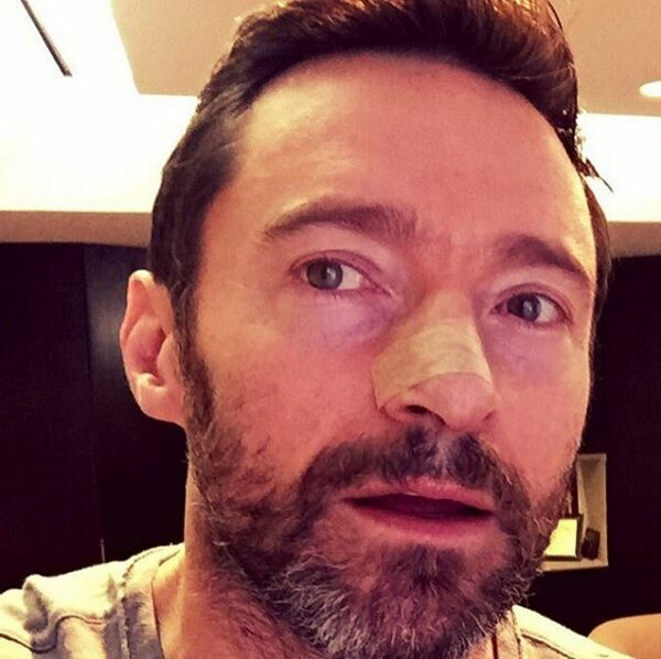 Ο Hugh Jackman μιλά για τον καρκίνωμα στη μύτη του και προειδοποιεί για τη χρήση αντηλιακού