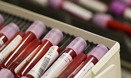 Τεστ αίματος υπολογίζει το προσδόκιμο ζωής