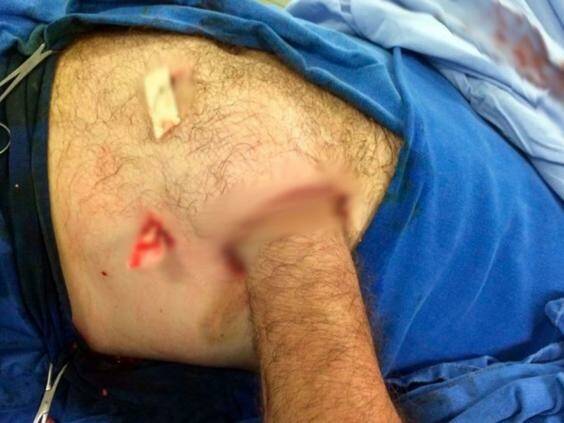 Οι γιατροί έσωσαν το χέρι ενός Βραζιλιάνου ράβοντάς το μέσα στην κοιλιά του