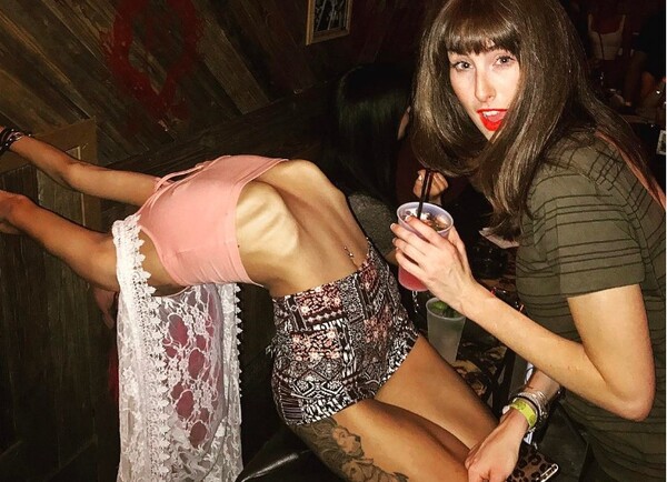 Το «Ribcage bragging» με τα πλευρά να προεξέχουν είναι η νέα ανησυχητική και ενοχλητική μόδα στα social media