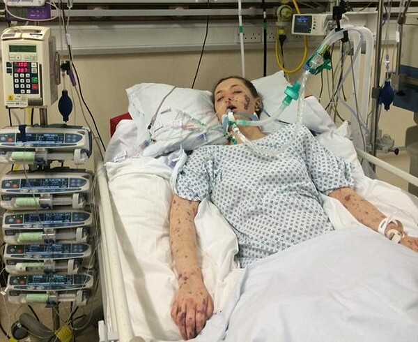Βρετανία: 18χρονη ποστάρει σοκαριστικές φωτογραφίες για να δείξει την "πραγματικότητα της μηνιγγίτιδας"