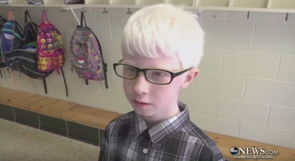 Ένας 10χρονος με αλμπινισμό βλέπει για πρώτη φορά τον κόσμο χάρη σε ένα πανάκριβο δώρο