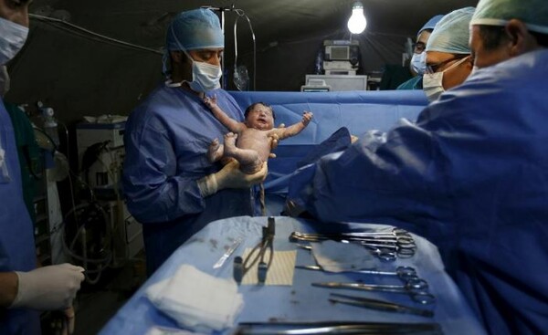 The Lancet: Πάνω από το ένα πέμπτο των μωρών στον κόσμο γεννιούνται πλέον με καισαρική