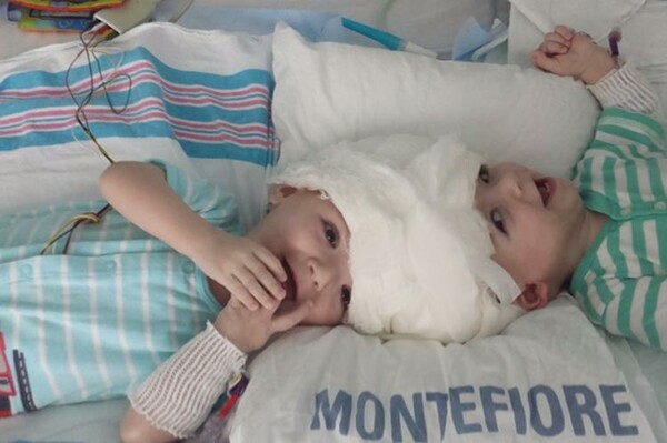 ΗΠΑ: Χειρουργοί διαχώρισαν σιαμαία αγοράκια ηλικίας 13 μηνών που ήταν ενωμένα στο κεφάλι